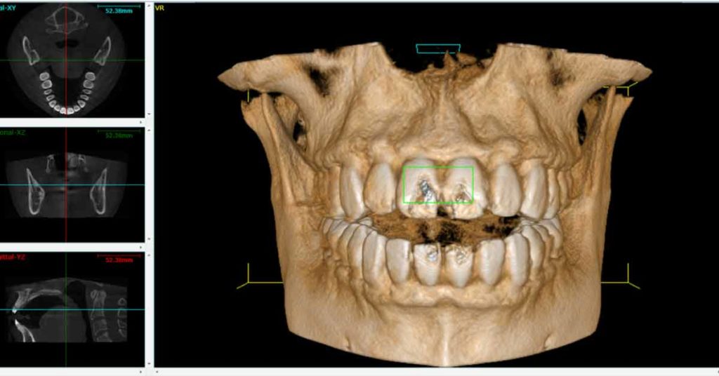 Tac Cone Beam | Vivi Sorridendo